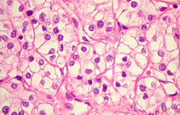 O Que é Carcinoma de Células Claras?